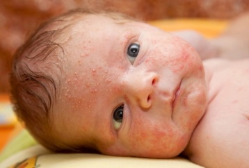 Bebê com acne.jpg