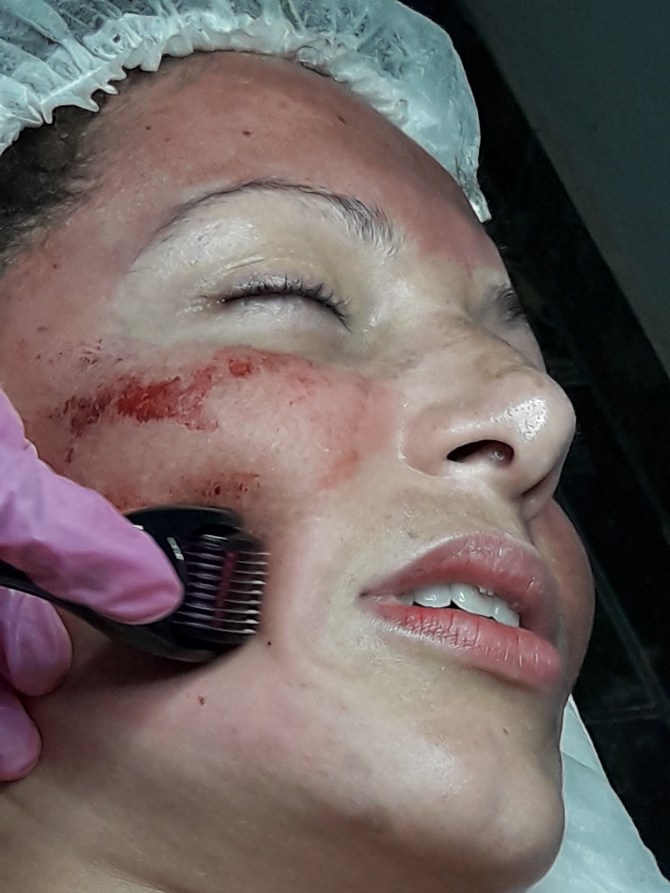 DERMAROLLER MELASMA.jpg