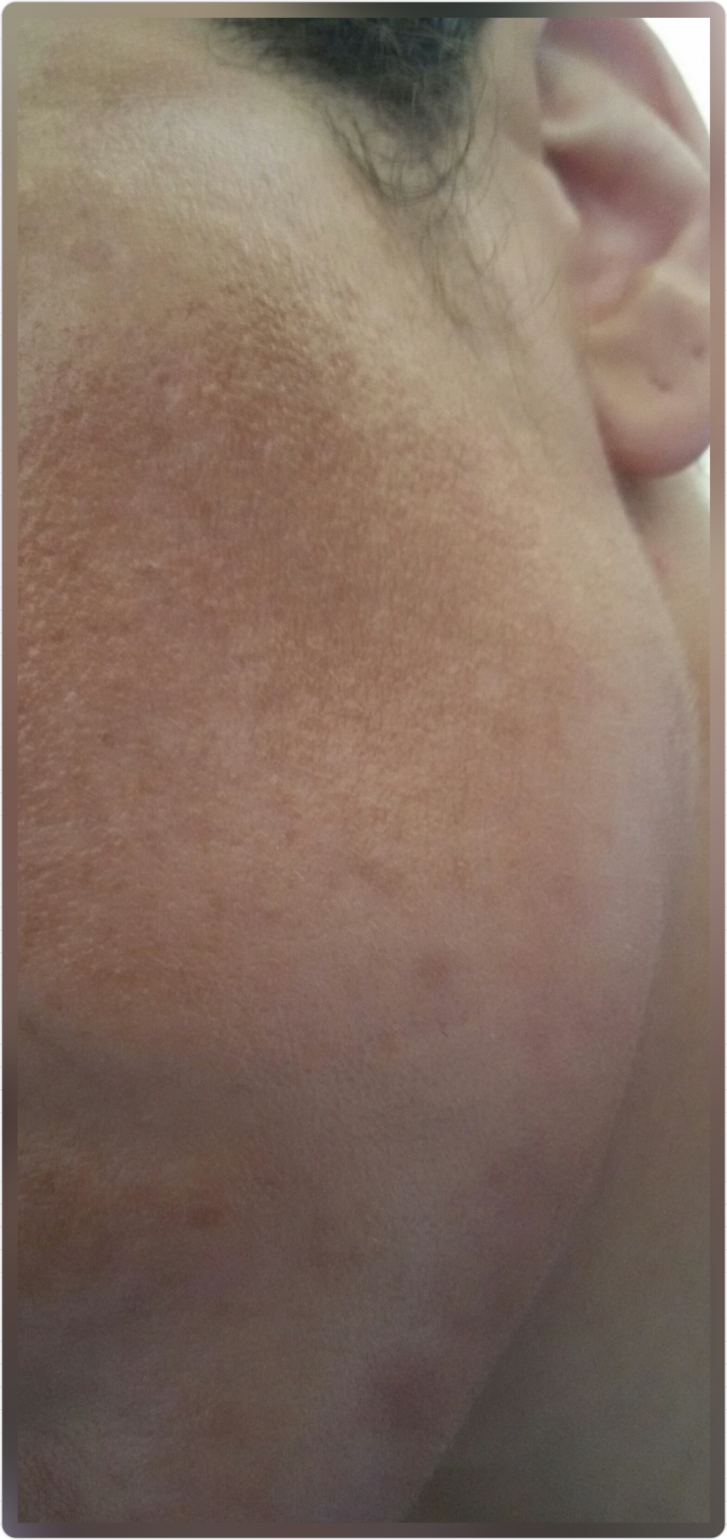 MELASMA PROFUNDO