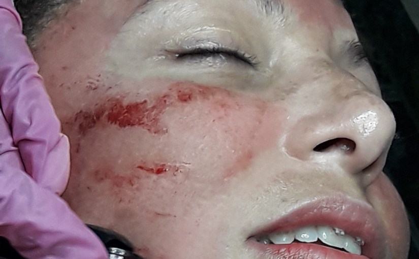 Melasma: Tratamento e algumas&nbsp;curiosidades!