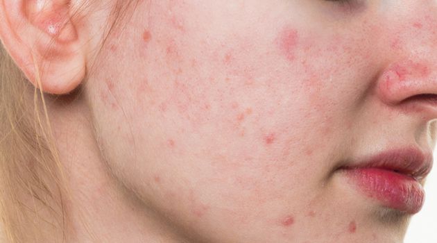Rosto manchado pós acne
