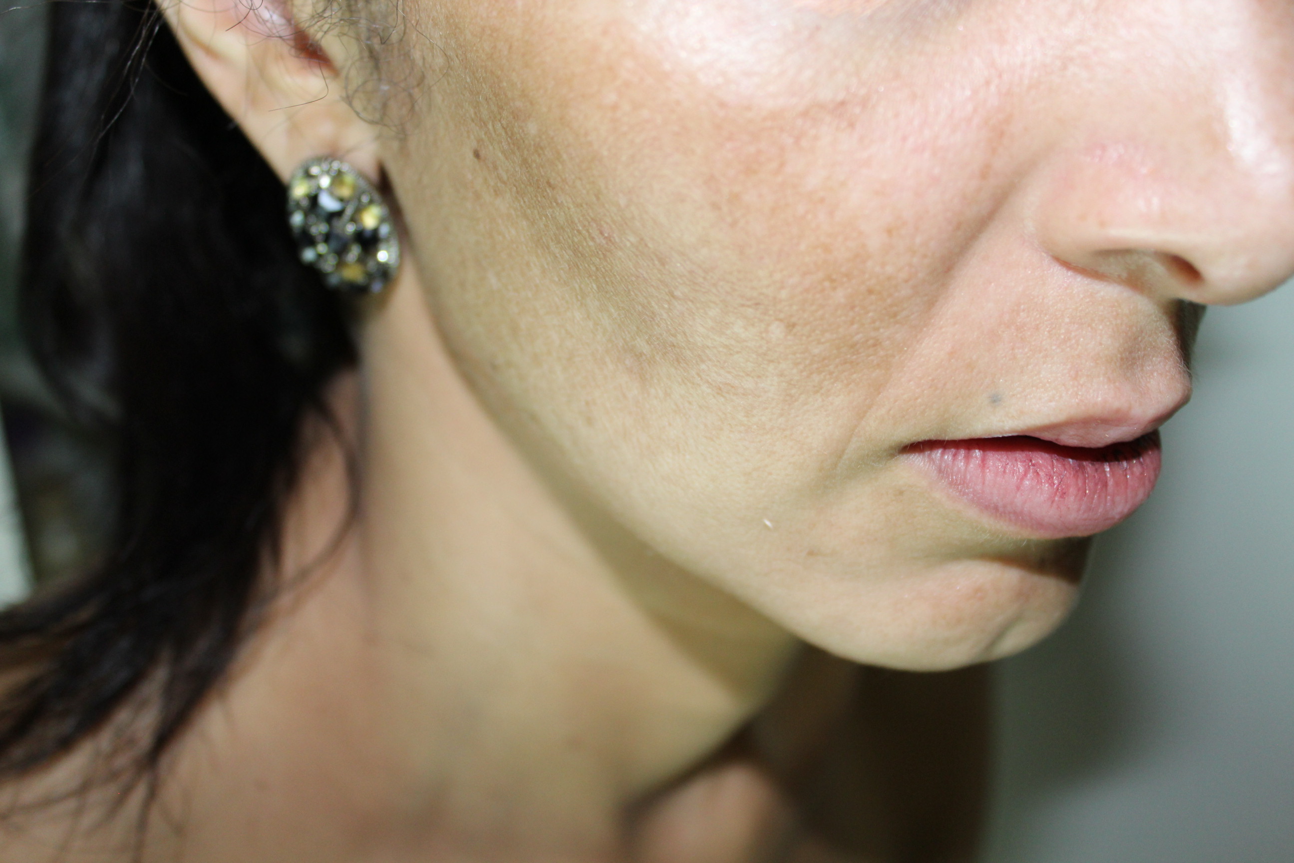 linhas finas e melasma.JPG